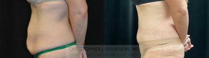 Tummy Tuck (Abdominoplasty) Case 389 Before & After Left Side | Boston, MA | Christopher J. Davidson, MD