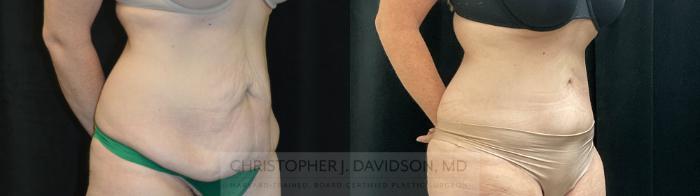 Tummy Tuck (Abdominoplasty) Case 389 Before & After Right Oblique | Boston, MA | Christopher J. Davidson, MD