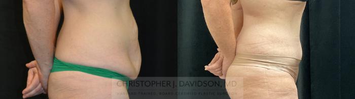 Tummy Tuck (Abdominoplasty) Case 389 Before & After Right Side | Boston, MA | Christopher J. Davidson, MD