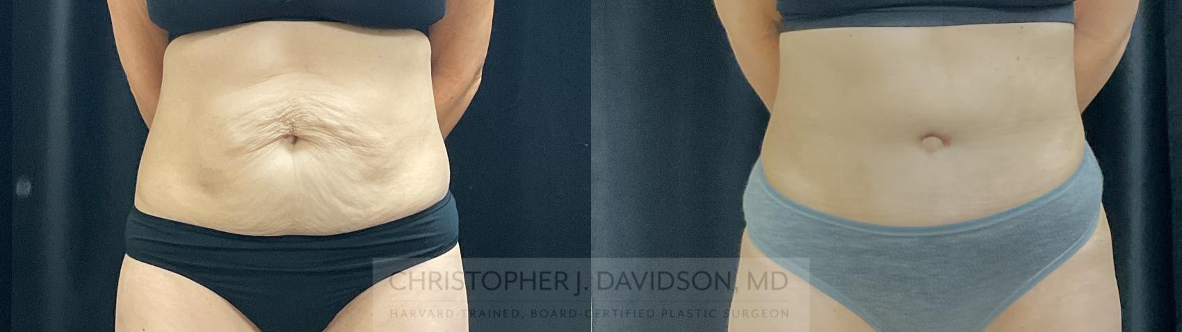 Tummy Tuck (Abdominoplasty) Case 390 Before & After Front | Boston, MA | Christopher J. Davidson, MD