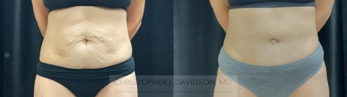 Tummy Tuck (Abdominoplasty) Case 390 Before & After Front | Boston, MA | Christopher J. Davidson, MD