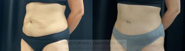 Tummy Tuck (Abdominoplasty) Case 390 Before & After Left Oblique | Boston, MA | Christopher J. Davidson, MD