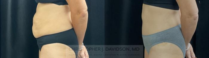 Tummy Tuck (Abdominoplasty) Case 390 Before & After Left Side | Boston, MA | Christopher J. Davidson, MD