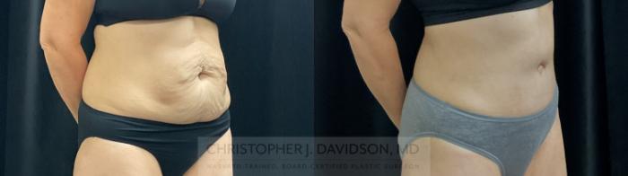 Liposuction Case 390 Before & After Right Oblique | Boston, MA | Christopher J. Davidson, MD