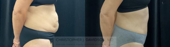 Liposuction Case 390 Before & After Right Side | Boston, MA | Christopher J. Davidson, MD