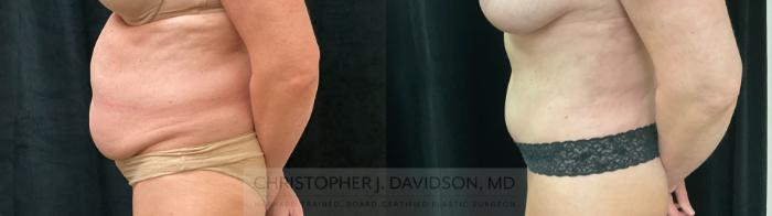 Tummy Tuck (Abdominoplasty) Case 391 Before & After Left Side | Boston, MA | Christopher J. Davidson, MD