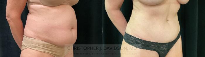 Liposuction Case 391 Before & After Right Oblique | Boston, MA | Christopher J. Davidson, MD