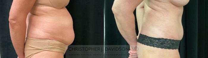 Liposuction Case 391 Before & After Right Side | Boston, MA | Christopher J. Davidson, MD