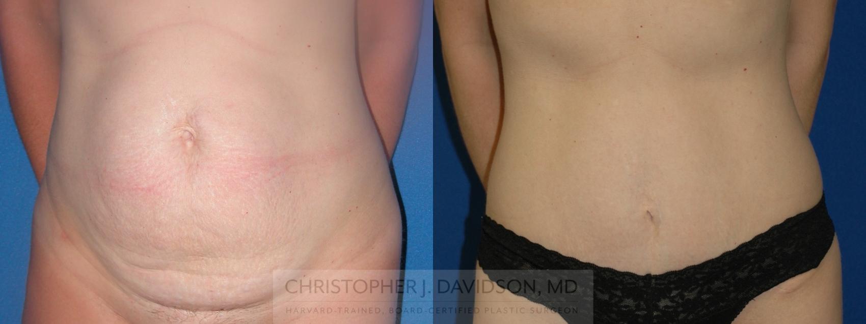 Tummy Tuck (Abdominoplasty) Case 398 Before & After Front | Boston, MA | Christopher J. Davidson, MD