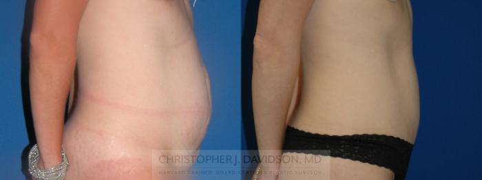 Tummy Tuck (Abdominoplasty) Case 398 Before & After Right Side | Boston, MA | Christopher J. Davidson, MD