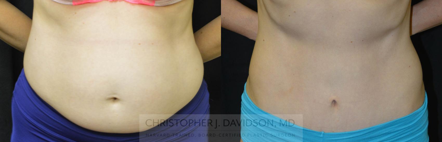 Tummy Tuck (Abdominoplasty) Case 40 Before & After View #1 | Wellesley, MA | Christopher J. Davidson, MD