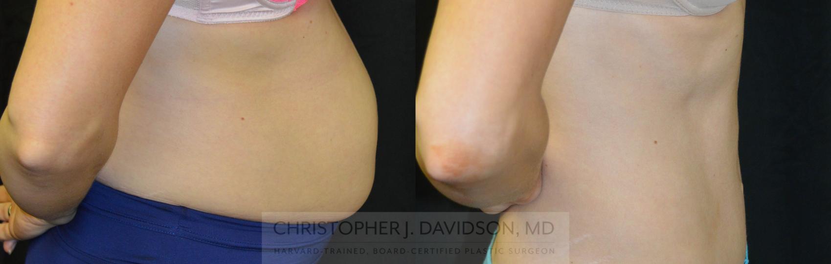 Tummy Tuck (Abdominoplasty) Case 40 Before & After View #2 | Wellesley, MA | Christopher J. Davidson, MD