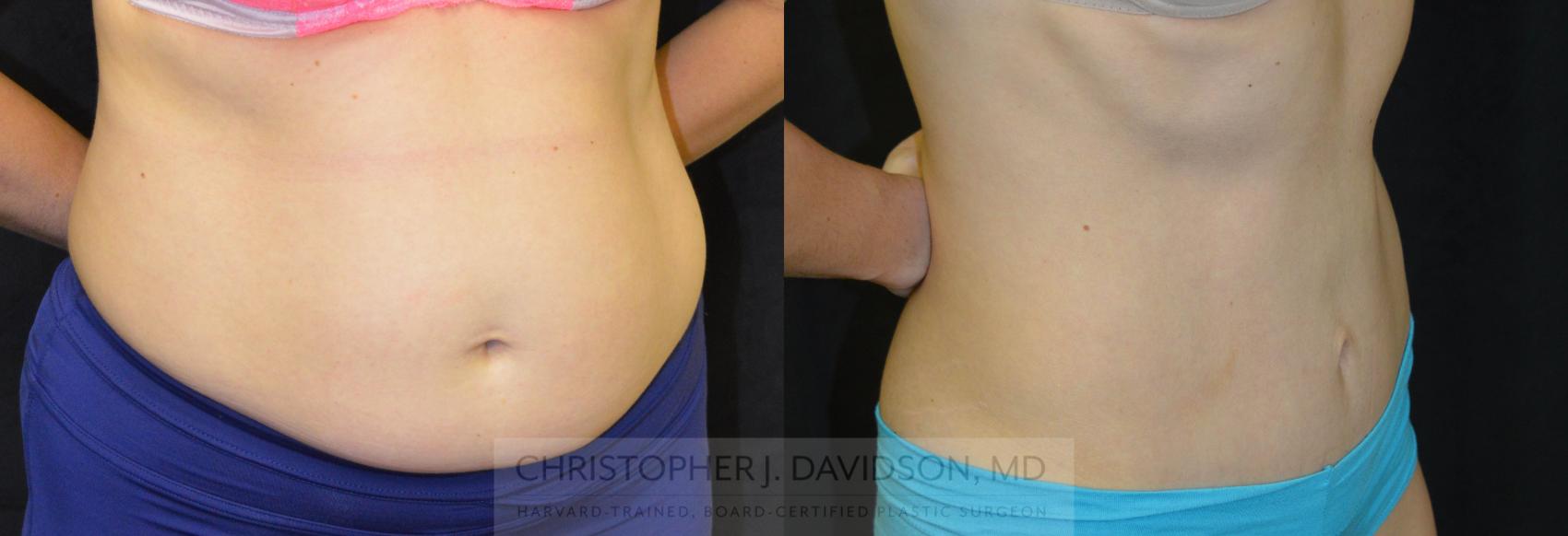 Tummy Tuck (Abdominoplasty) Case 40 Before & After View #3 | Wellesley, MA | Christopher J. Davidson, MD