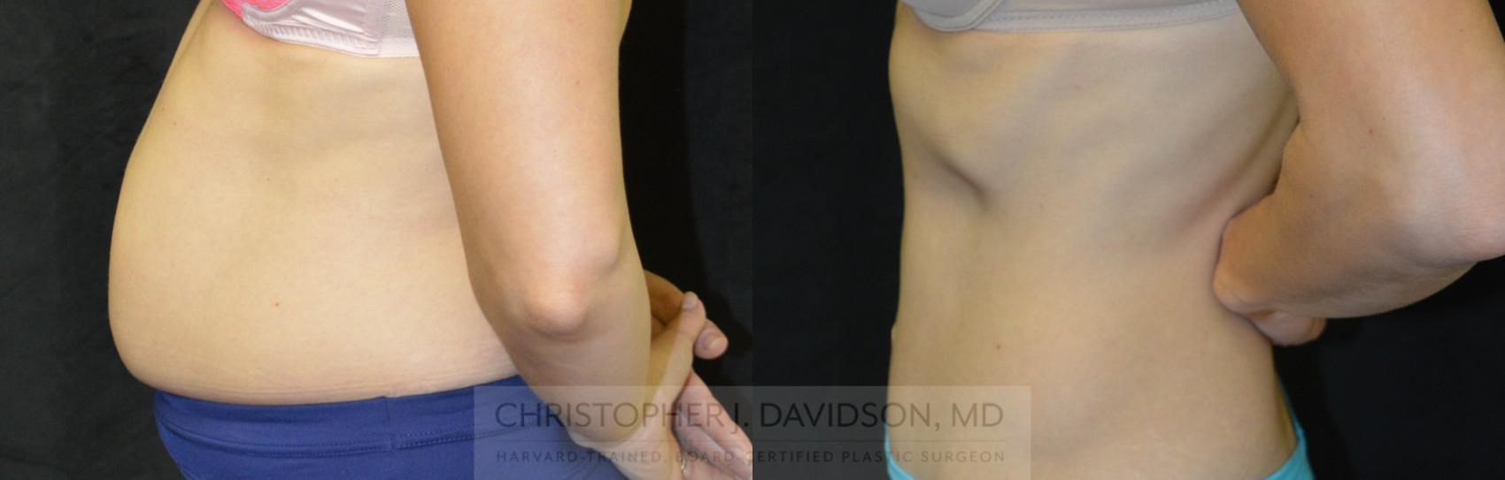 Tummy Tuck (Abdominoplasty) Case 40 Before & After View #4 | Wellesley, MA | Christopher J. Davidson, MD