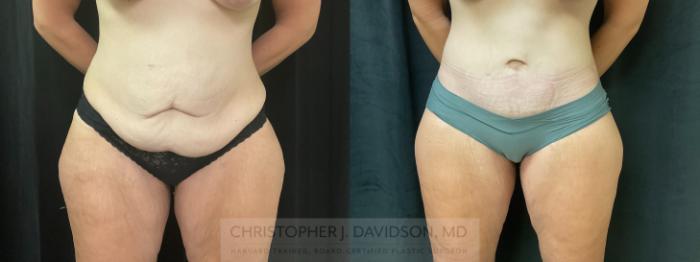 Tummy Tuck (Abdominoplasty) Case 425 Before & After Front | Boston, MA | Christopher J. Davidson, MD