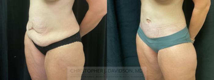 Tummy Tuck (Abdominoplasty) Case 425 Before & After Left Oblique | Boston, MA | Christopher J. Davidson, MD