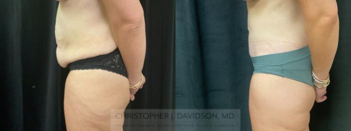 Tummy Tuck (Abdominoplasty) Case 425 Before & After Left Side | Boston, MA | Christopher J. Davidson, MD