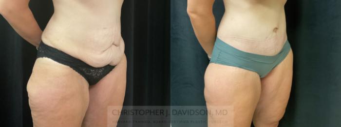 Tummy Tuck (Abdominoplasty) Case 425 Before & After Right Oblique | Boston, MA | Christopher J. Davidson, MD