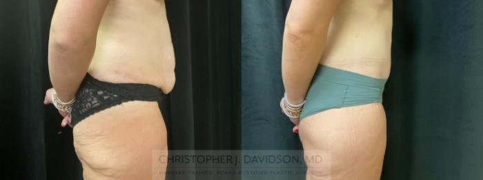 Tummy Tuck (Abdominoplasty) Case 425 Before & After Right Side | Boston, MA | Christopher J. Davidson, MD