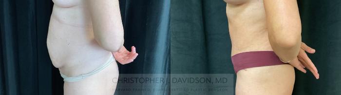 Tummy Tuck (Abdominoplasty) Case 440 Before & After Left Side | Boston, MA | Christopher J. Davidson, MD