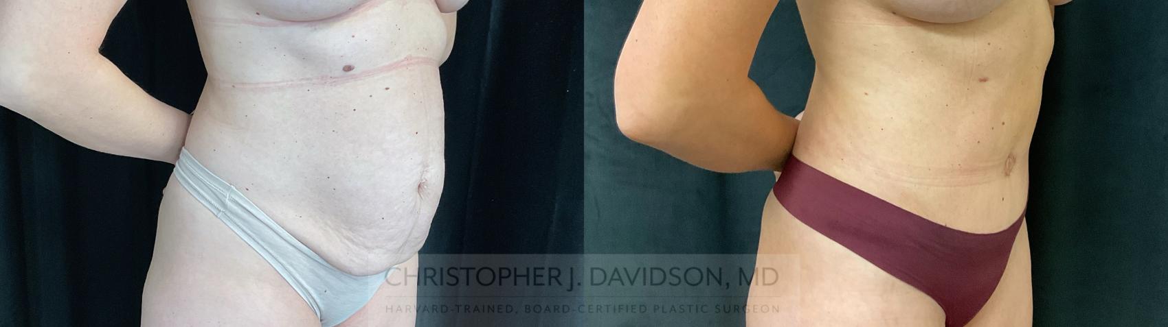 Tummy Tuck (Abdominoplasty) Case 440 Before & After Right Oblique | Boston, MA | Christopher J. Davidson, MD