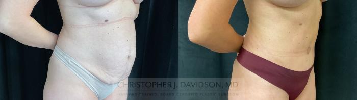 Tummy Tuck (Abdominoplasty) Case 440 Before & After Right Oblique | Boston, MA | Christopher J. Davidson, MD