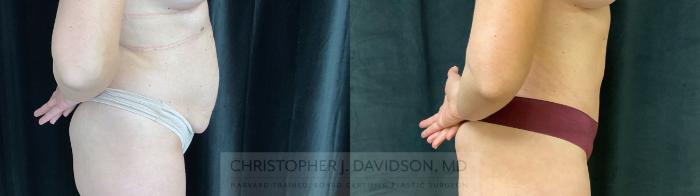 Tummy Tuck (Abdominoplasty) Case 440 Before & After Right Side | Boston, MA | Christopher J. Davidson, MD