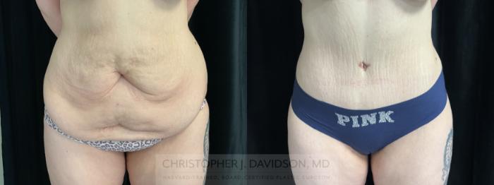 Liposuction Case 450 Before & After Front | Boston, MA | Christopher J. Davidson, MD