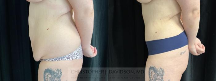Liposuction Case 450 Before & After Left Side | Boston, MA | Christopher J. Davidson, MD