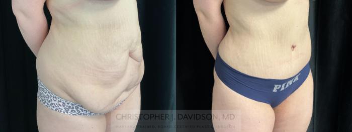 Liposuction Case 450 Before & After Right Oblique | Boston, MA | Christopher J. Davidson, MD