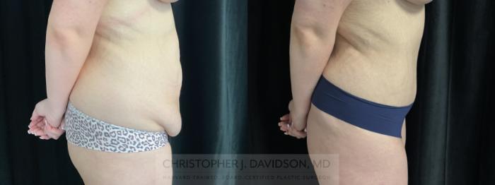 Liposuction Case 450 Before & After Right Side | Boston, MA | Christopher J. Davidson, MD