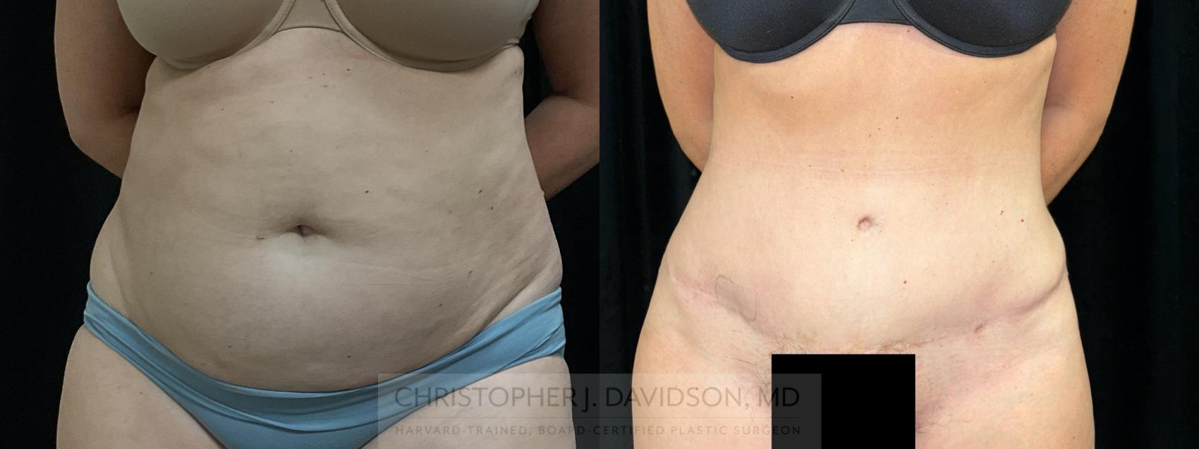 Tummy Tuck (Abdominoplasty) Case 459 Before & After Front | Boston, MA | Christopher J. Davidson, MD