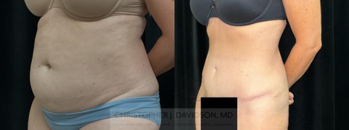 Tummy Tuck (Abdominoplasty) Case 459 Before & After Left Oblique | Boston, MA | Christopher J. Davidson, MD