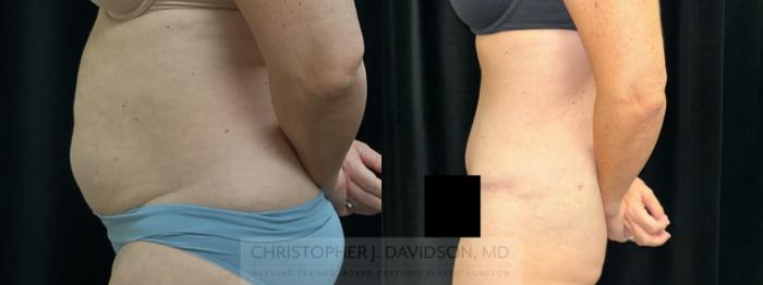 Tummy Tuck (Abdominoplasty) Case 459 Before & After Left Side | Boston, MA | Christopher J. Davidson, MD