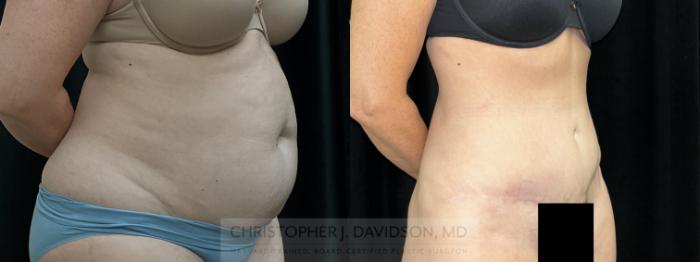Tummy Tuck (Abdominoplasty) Case 459 Before & After Right Oblique | Boston, MA | Christopher J. Davidson, MD