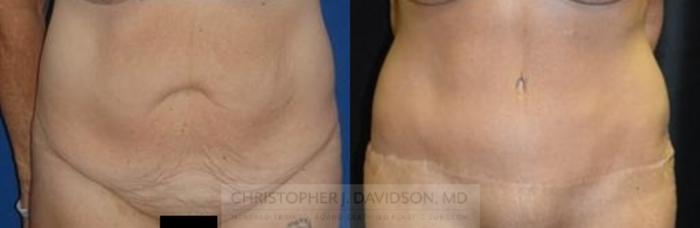 Tummy Tuck (Abdominoplasty) Case 46 Before & After View #1 | Boston, MA | Christopher J. Davidson, MD