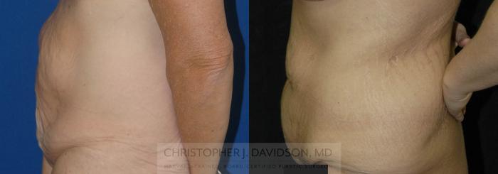 Tummy Tuck (Abdominoplasty) Case 46 Before & After View #2 | Boston, MA | Christopher J. Davidson, MD