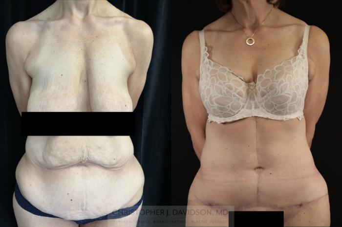 Tummy Tuck (Abdominoplasty) Case 476 Before & After Front | Boston, MA | Christopher J. Davidson, MD