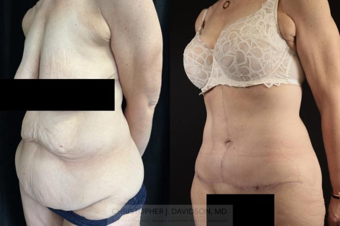 Tummy Tuck (Abdominoplasty) Case 476 Before & After Left Oblique | Boston, MA | Christopher J. Davidson, MD