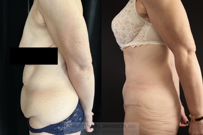 Tummy Tuck (Abdominoplasty) Case 476 Before & After Left Side | Boston, MA | Christopher J. Davidson, MD