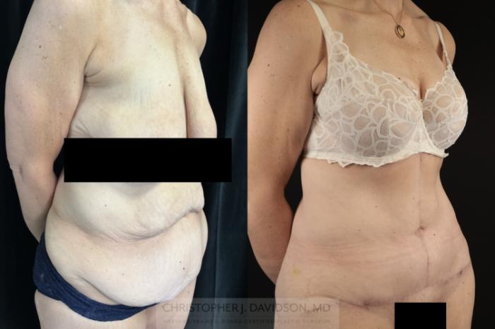 Tummy Tuck (Abdominoplasty) Case 476 Before & After Right Oblique | Boston, MA | Christopher J. Davidson, MD