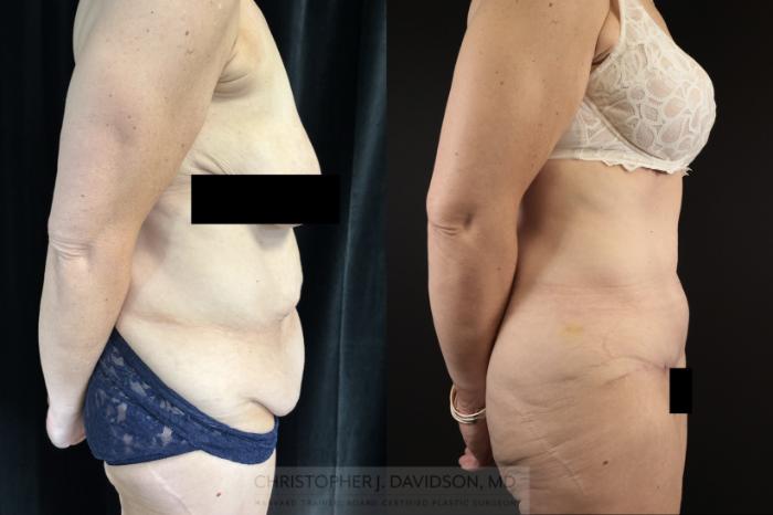 Tummy Tuck (Abdominoplasty) Case 476 Before & After Right Side | Boston, MA | Christopher J. Davidson, MD