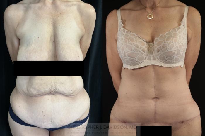 Tummy Tuck (Abdominoplasty) Case 481 Before & After Front | Boston, MA | Christopher J. Davidson, MD