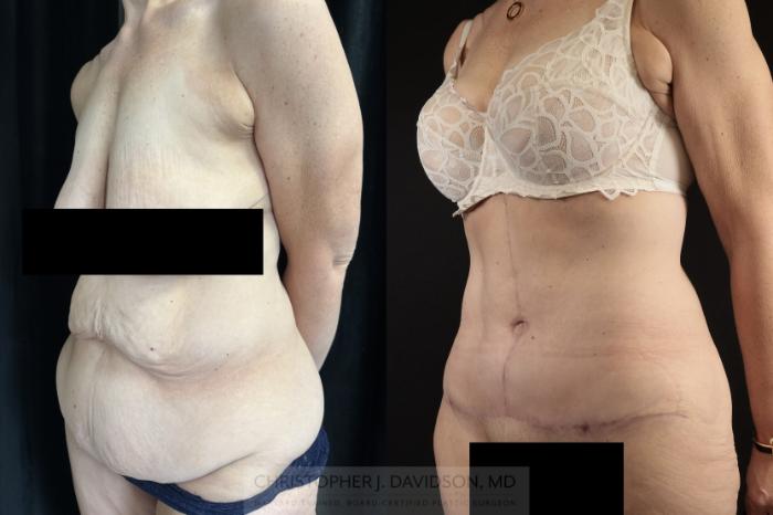 Tummy Tuck (Abdominoplasty) Case 481 Before & After Left Oblique | Boston, MA | Christopher J. Davidson, MD