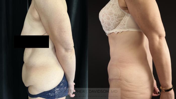 Tummy Tuck (Abdominoplasty) Case 481 Before & After Left Side | Boston, MA | Christopher J. Davidson, MD