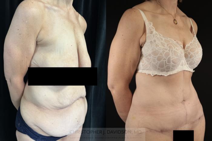 Tummy Tuck (Abdominoplasty) Case 481 Before & After Right Oblique | Boston, MA | Christopher J. Davidson, MD