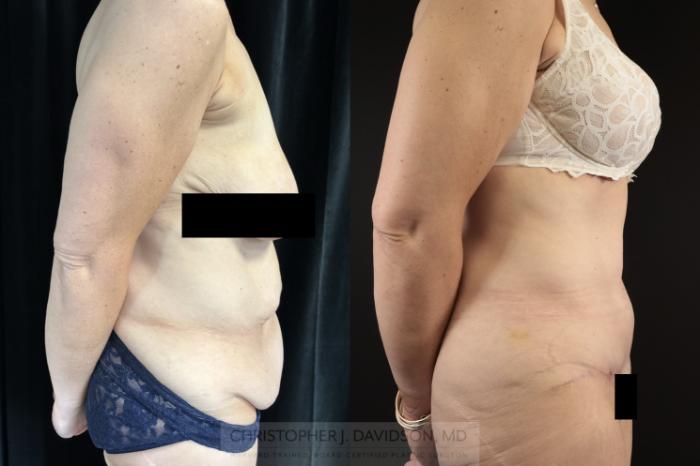Tummy Tuck (Abdominoplasty) Case 481 Before & After Right Side | Boston, MA | Christopher J. Davidson, MD