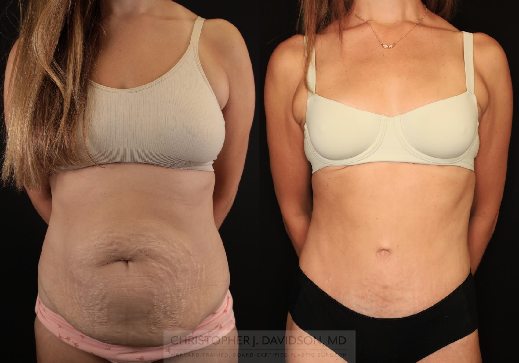 Tummy Tuck (Abdominoplasty) Case 494 Before & After Front | Boston, MA | Christopher J. Davidson, MD