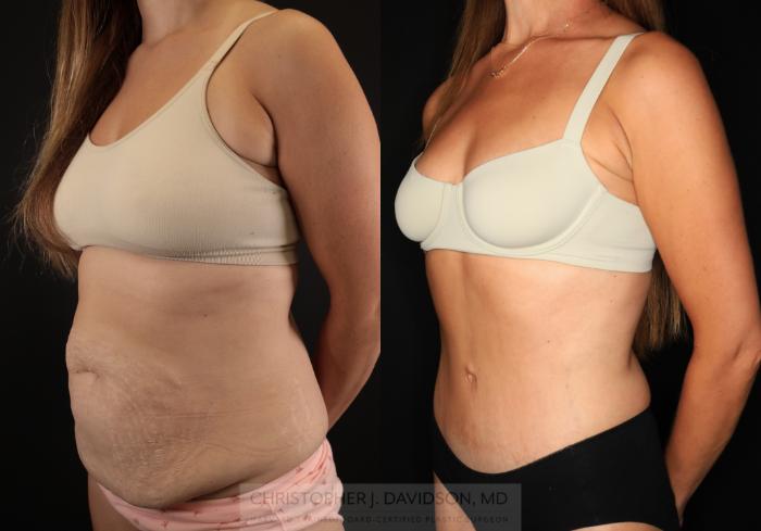 Tummy Tuck (Abdominoplasty) Case 494 Before & After Left Oblique | Boston, MA | Christopher J. Davidson, MD