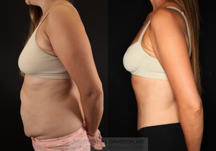 Tummy Tuck (Abdominoplasty) Case 494 Before & After Left Side | Boston, MA | Christopher J. Davidson, MD